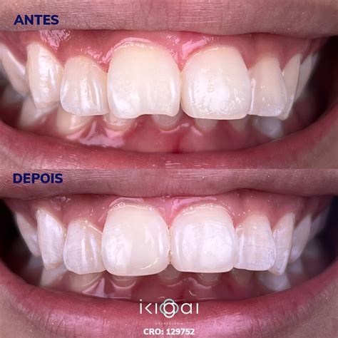 Restauração De Dente Doi - restauração em resina composta – Ikigai Odontologia