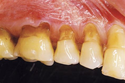 ᐈ Desgaste Dental Abrasión Atrición Erosión Y Abfracción 🥇🥇