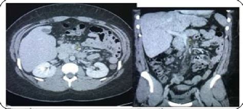 a, b: CT angiogram of the abdomen showing a small localized ...