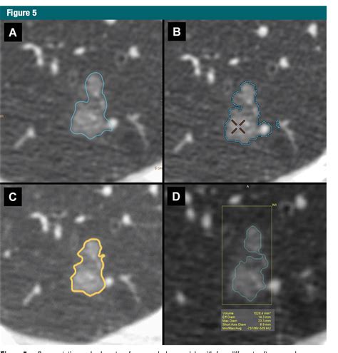 Figure From Recommendations For Measuring Pulmonary Nodules At Ct A