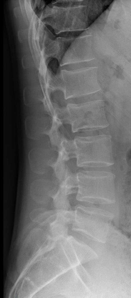 Lumbar Spine X Ray Anatomy