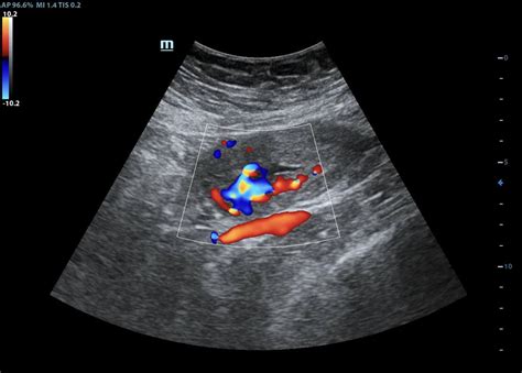 Uterine Arteriovenous Malformation Image