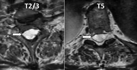 Transverse T2w Turbo Spin Echo Tse Images At Level T23 And T5 With