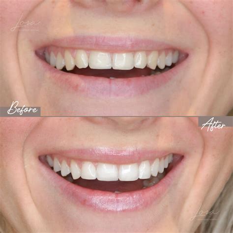 Carillas De Composite Barcelona Lora Boutique Dental