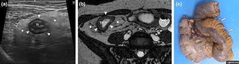 Terminal Ileitis In A 36 Year Old Man A Transversal B Mode Us Image Download Scientific