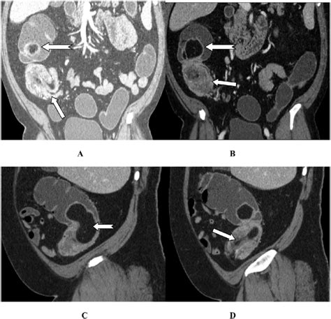 Ct Scan Cmpr Aandb And Smpr Candd Showing Ileocecal Intussusception Download Scientific Diagram