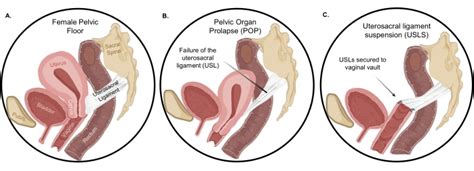 Development Of A Uterosacral Ligament Suspension Rat Model