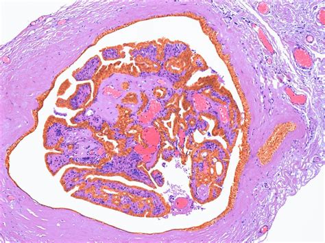 Intraductal Papilloma By Steve Gschmeissner