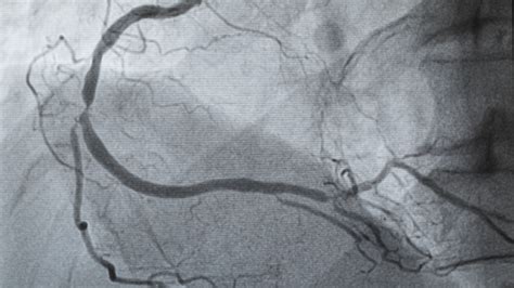 Koronarografia co powinieneś wiedzieć o tym badaniu
