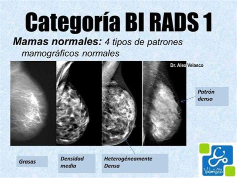 BIRADS en mamografia Centro de Diagnóstico por Imágenes Linda Vista