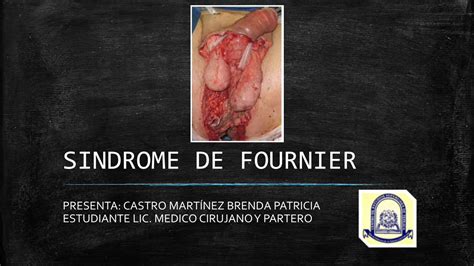 Pdf Sindrome De Fournier Fascitis Necrotizante Dokumen Tips