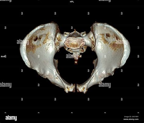 Ct Scan Of Pelvic Bone And Hip Joint 3d Rendering For Diagnosis