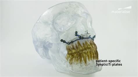 Patient Specific Cranio Maxillofacial Cmf Implants Materialise