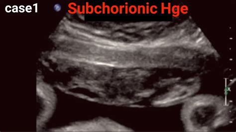 Abruptio Placentae Ultrasound Basics Youtube