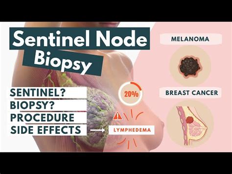 Sentinel Lymph Node Biopsy: Procedure and Side Effects | SchoolTube