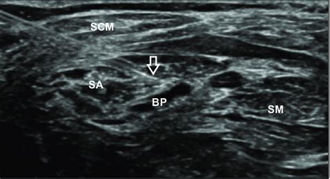 Scalenus Anterior