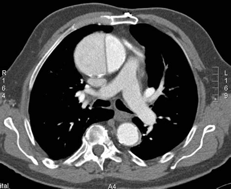 Dissection Aortique PinkyBone