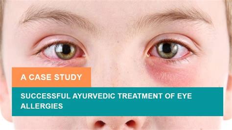 Successful Ayurvedic Treatment of Eye Allergies - A Case Study