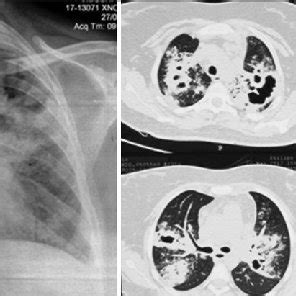 Chest X-ray posteroanterior and computed tomography chest view at the ...