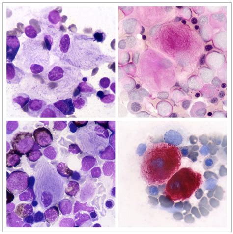 Images From The Haematologica Atlas Of Hematologic Cytology Gaucher