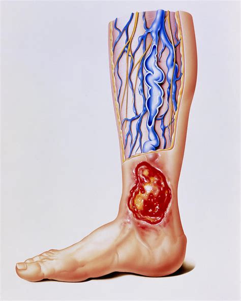 Artwork Of Varicose Veins And Ulcer On Leg Photograph By John Bavosi