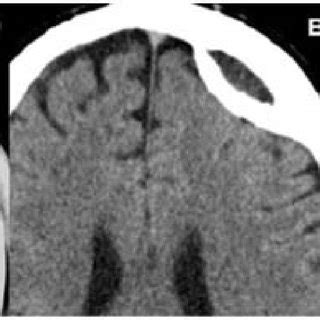 Same Patient In Figure A Axial Non Contrat Ct Scan One Month Later