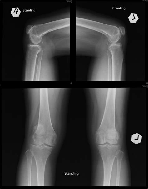 Familial Patellar Dislocation Associated With T1520 Q24q131 Cm