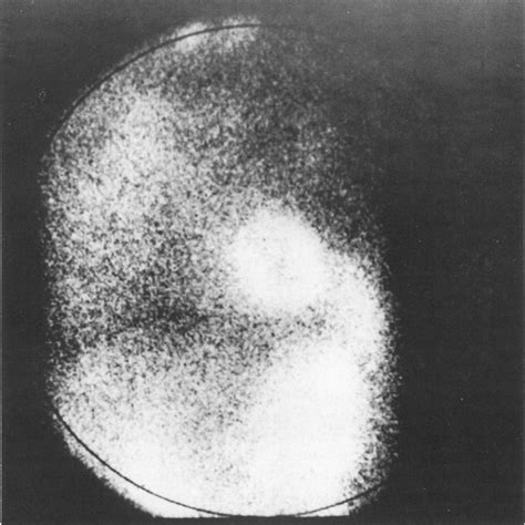 Normal thallium 201 scan exhibiting ST elevation after intravenous ...