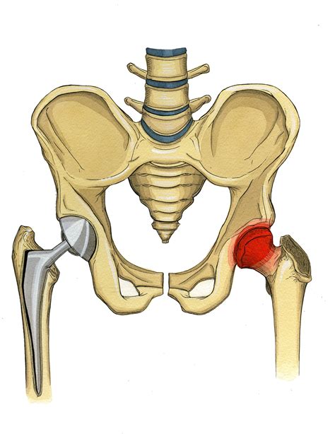 Hip labral tear symptoms causes treatments – Artofit