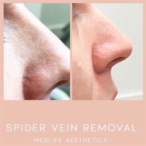 Spider Vein Removal Artofit