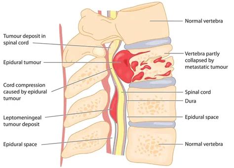 Spinal Tumor Causes Symptoms Diagnosis