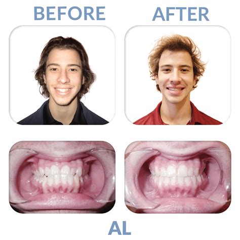 Before And Afters Miler Orthodontics Orthodontist Sc 29910