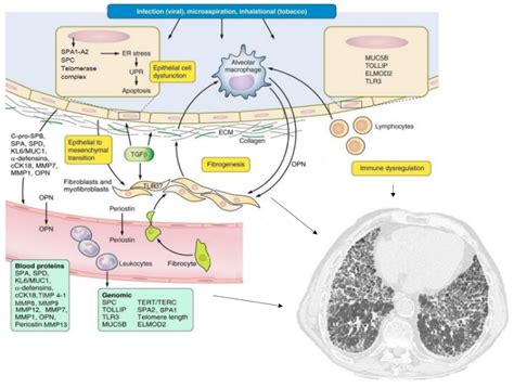 Idiopathic Pulmonary Fibrosis Mechanisms Idiopathic Pulmonary Fibrosis