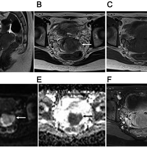 34 Year Old Woman With Figo Stage Ib2 Uterine Cervical Large Cell Download Scientific Diagram