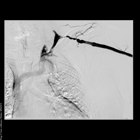 Figure 1 From Arteriovenous Fistulas And Hypoperfusion Ischemic