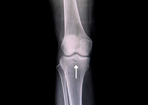 Tibial Intercondylar Eminence