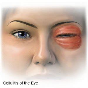 Orbital Cellulitis - What You Need to Know