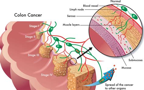 Colorectal Cancer Stages And Subtypes