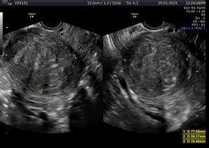 | fibroid | Diagnostic Ultrasound