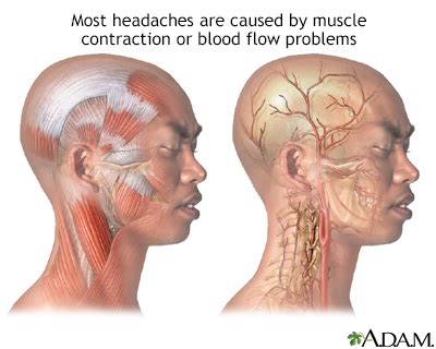 Tension Headache Exercise Online Degrees