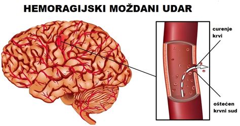 Centar za moždani udar Kardiološki centar Puls