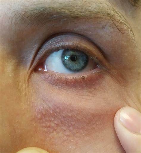 Кожа под глазами - Вопрос дерматологу - 03 Онлайн