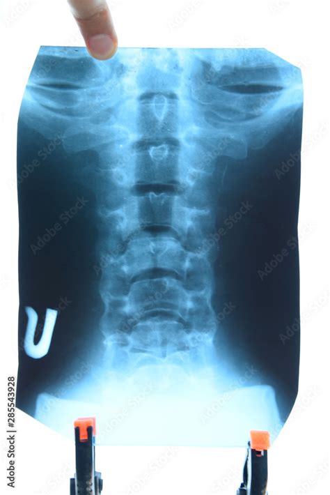 X-ray of the cervical vertebrae. X ray image of the cervical spine ...