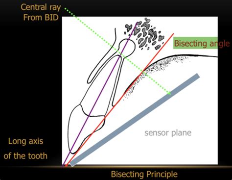 Principle Of Intraoral Radiography Technique Errors Bsoul