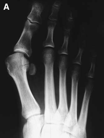 Ludloff Osteotomy In A Year Old Man A Incongruent Mtp Joint