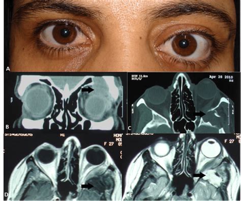 25 Year Old Female With Epidermoid Cyst Associated With Intracranial