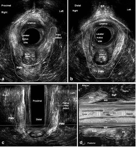 Pdf Usefulness Of Anorectal And Endovaginal D Ultrasound In The