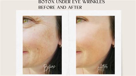 Botox under eye wrinkles Before and After