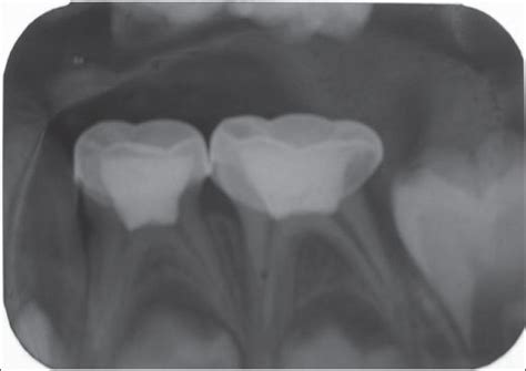 Post Operative Radiograph After The Stainless Steel Crown Placement For