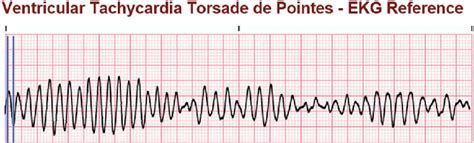 Torsades De Pointes Medizzy